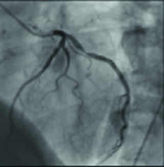 the angiogram